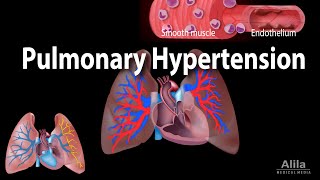 Pulmonary Hypertension Animation [upl. by Kcirdot]