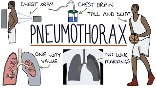 Pneumothorax [upl. by Sitelc123]