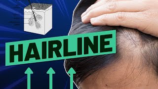 Uneven Hairline How To Fix It And What Causes It [upl. by Ainslie]