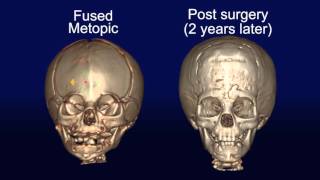 Cranial Flap Fixation [upl. by Werdnael]