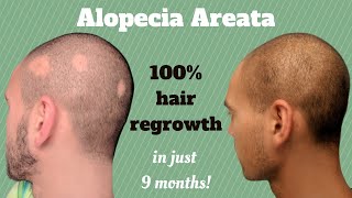 Alopecia Areata – Why does my hair fall out [upl. by Gierk]