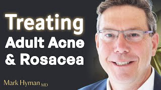 Treating Adult Acne amp Rosacea From The Inside Out [upl. by Adrial]