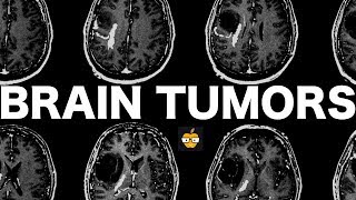 Brain Tumors [upl. by Adkins]