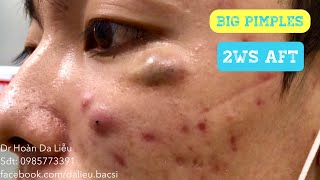 Mụn trứng cá mặt cực nặngDermatologist pimples whitehead blackhead anti acne 2 weeks after [upl. by Htide]