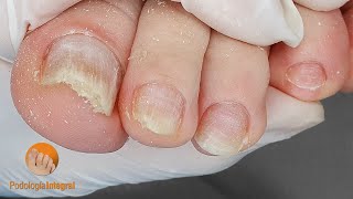 Toenail fungus cleaning [upl. by Auqinom52]