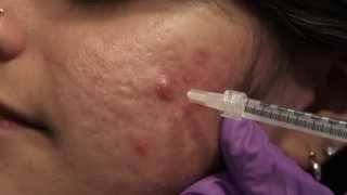 Watch amp Learn Intralesional injections [upl. by Ahsenyl]