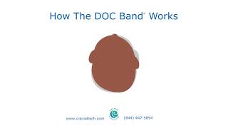 How The DOC Band® Works [upl. by Elbring50]