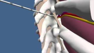 Techniques for Thoracic Paravertebral Block TPVB [upl. by Gabbert470]