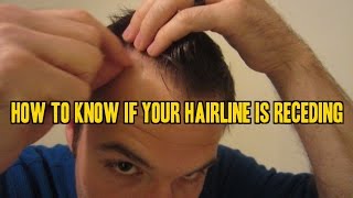 How to Know If Your Hairline is Receding [upl. by Lebazej972]