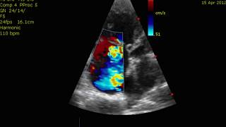 Echocardiogram Cor Pulmonale PHTN Pulmonary Hypertension [upl. by Atikahc95]