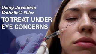 Dermal Filler Under Eyes Tear Trough Restylane and Radiesse [upl. by Loveridge424]