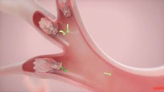 How It Works Zephyr Valve Treatment for COPD amp Emphysema [upl. by Greenburg]