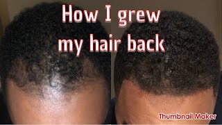 How to grow back receding hairline [upl. by Nofpets550]