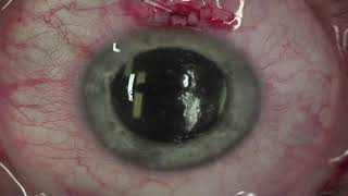 Canaloplasty perspectives  Video Abstract ID 155057 [upl. by Driscoll]