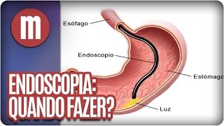 Endoscopia Quando fazer  Mulheres 120916 [upl. by Kramal220]