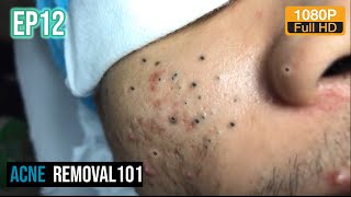 Cystic Acne Extraction 30mn  Blackheads Removal by ACNEREMOVAL101 [upl. by Irec]