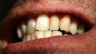 How to Straighten Crooked Teeth  Tooth Care [upl. by Ekusuy]