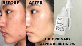 THE ORDINARY ALPHA ARBUTIN 2  HA REVIEW  BEFORE amp AFTER 6 WEEKS [upl. by Ragse397]