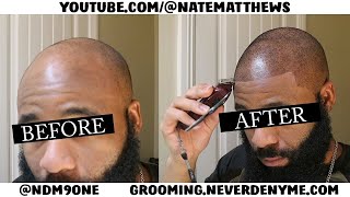 How To Get Your Hairline Back  From Bald To Edge Up  Hairline Restoration [upl. by Leimaj]