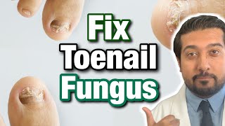 How to Treat Toenail Fungus CORRECTLY  Easy Steps 2021 [upl. by Aissat]