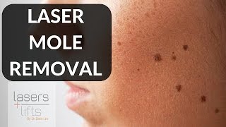 LASER MOLE REMOVAL [upl. by Lednew]