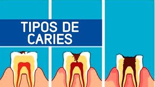 Tipos de caries  Odontoespecialistas [upl. by Kciderf]