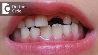 Class II Composite Preparation for ADEX Caries 30 MO [upl. by Kaylil858]