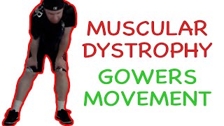 Muscular Dystrophy Gowers Maneuver [upl. by Susanna]