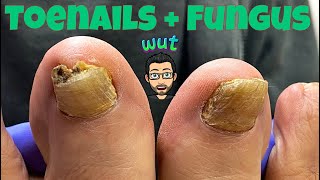 HOW TO CUT THICK TOENAILS WITH FUNGUS [upl. by Dolora]