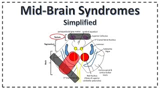 MidBrain Syndromes  Weber Syndrome  Benedikt Syndrome  Parinauds Syndrome [upl. by Edan428]