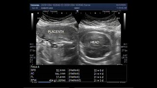 Ultrasound Video showing Oligohydromnios loss of fetal movements with Pregnancy of about 22 weeks [upl. by Anyar]