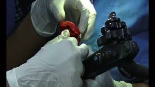 Endoscopic banding of esophageal varices [upl. by Hoashis]