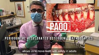 Adult Orthodontics PAOO [upl. by Kariv]