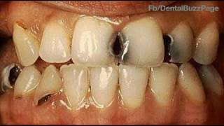 Difference between Early Childhood Caries amp Rampant Caries  Dr Sumanth M Shetty [upl. by Llen]