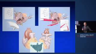 Surgical Pulmonary Vein IsolationMAZE  Dr Michael Yii [upl. by Ennaed]