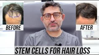 STEM CELL Hair Restoration 4 month Update [upl. by Annai148]