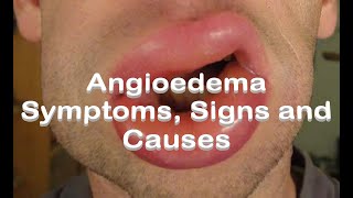 Angioedema  Symptoms Signs and Causes [upl. by Einobe]