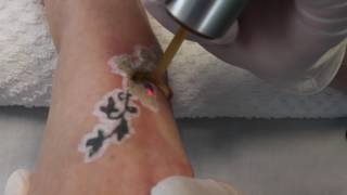 PicoWay Tattoo Removal [upl. by Osbourn]