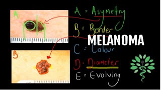 Melanoma  Symptoms signs diagnosis and management [upl. by Iosep446]