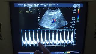 REVERSAL OF END DIASTOLIC BLOOD FLOW IN UMBILICAL ARTERY [upl. by Krahmer211]