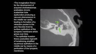 ENT Cholesteatoma Types Treat Wittmaack Ruedi Sade Habermann Laws view Classify [upl. by Ellened730]