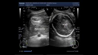 Ultrasound Video showing Oligohydromnios  almost Anhydramnios  with Pregnancy of 30 weeks [upl. by Yoho]