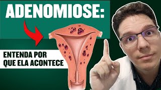 ADENOMIOSE UTERINA VEJA QUAIS SÃO OS SINTOMAS E COMO É FEITO O DIAGNÓSTICO E TRATAMENTO [upl. by Eivol940]