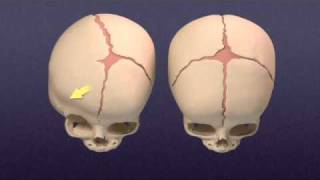 Navigating A Diagnosis of Craniosynostosis [upl. by Ayotahs]