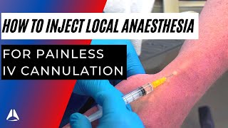 How to Inject Local Anaesthetic before IV cannulation [upl. by Schell1]