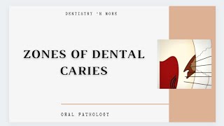 DENTAL CARIES ZONES [upl. by Yltnerb]