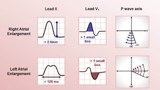 Intro to EKG Interpretation  Chamber Enlargement [upl. by Karly324]