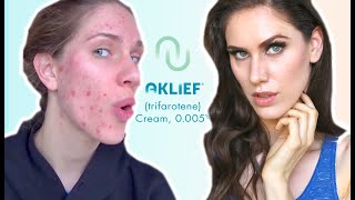 FIRST NEW ACNE MED IN 20 YEARS  AKLIEF  Trifarotene Cream 0005 Review amp Impressions [upl. by Ynneh]