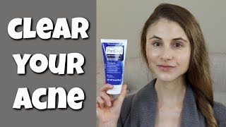 HOW TO CLEAR YOUR SKIN WITH BENZOYL PEROXIDE DR DRAY [upl. by Ytnom]