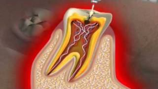 Aspectos Radiograficos de la Caries Dental [upl. by Germann]